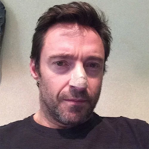 На фото Хью Джекмана в Instagram обращает внимание заклеенный пластырем нос. 